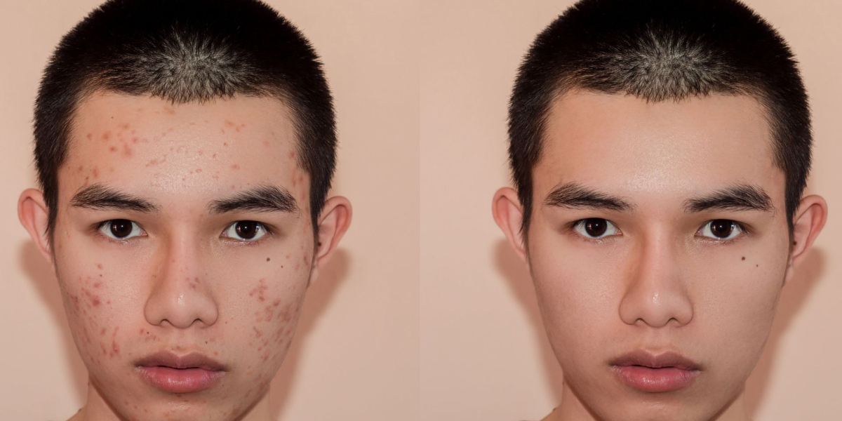 When to Start Pimples Treatment in Dubai