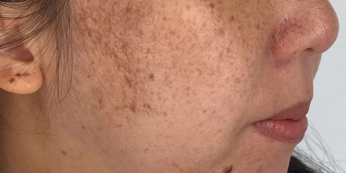 Melasma Treatment Explained in Simple Terms