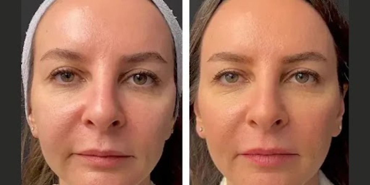 Mesotherapy Treatment in Dubai: From Consultation to Results