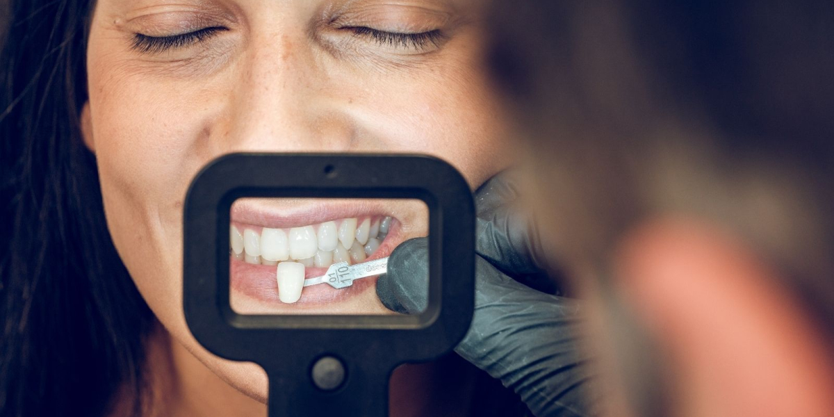 Veneers in Dubai for Stained Teeth Solutions