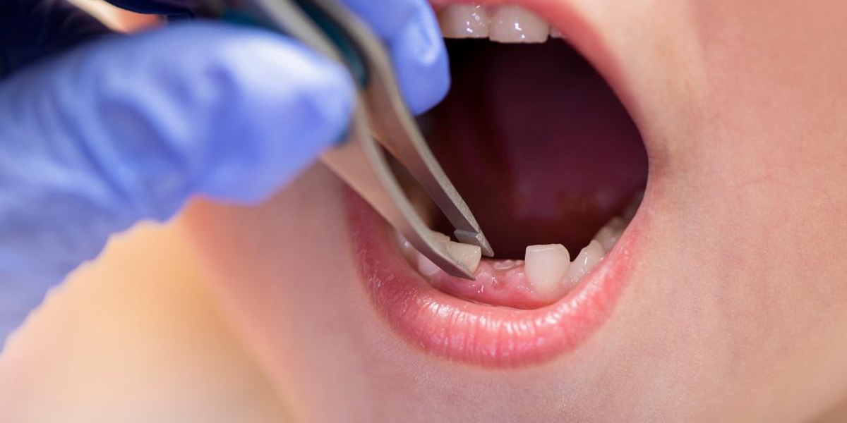 Cheapest Tooth Extraction A Practical Guide to Tooth Removal