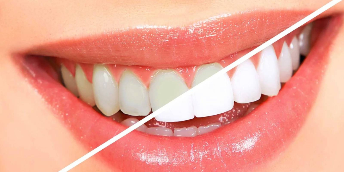 Teeth Whitening in Dubai: Benefits and Side Effects