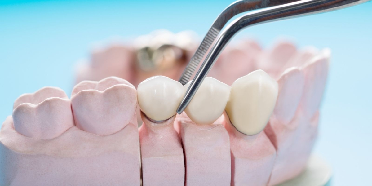 Dental Implant Cost In Dubai Clinic Comparison Guide