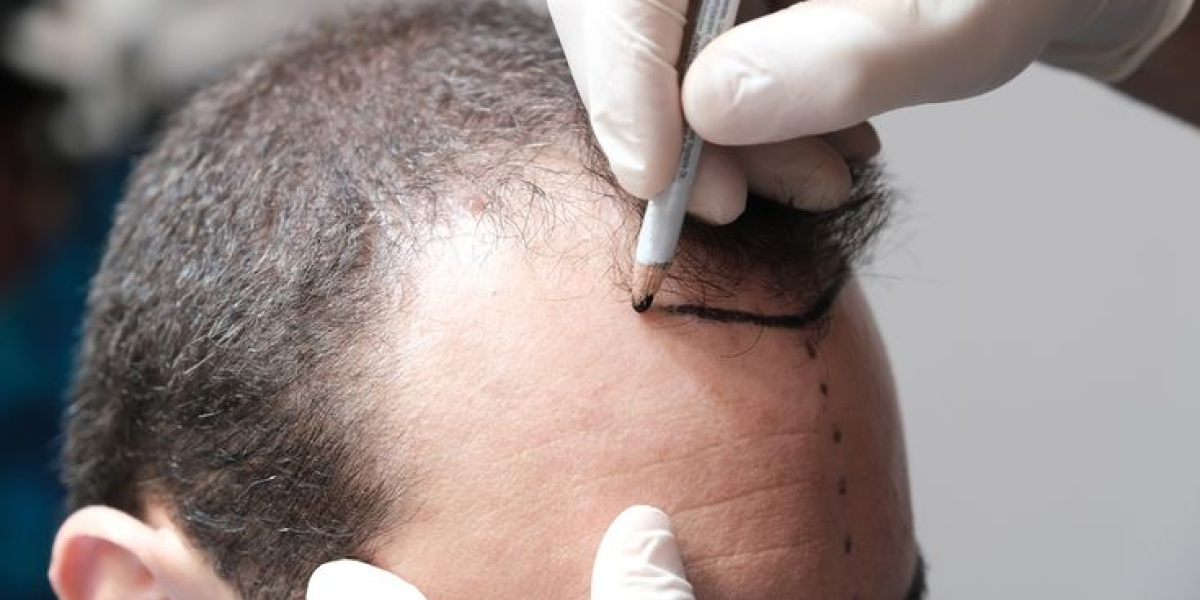 Hair Transplant Achieving Long-Lasting Hair Growth