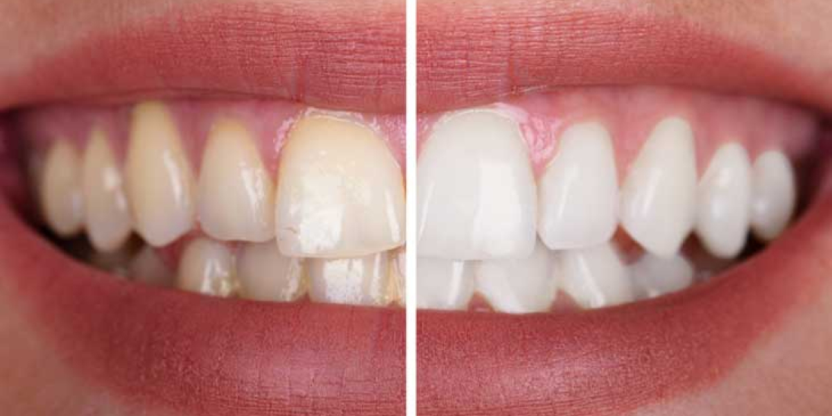 Glow Shine Rise Teeth Whitening for Bold Radiant Smile Look