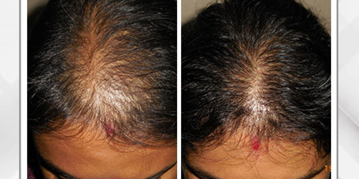 Alopecia Areata Treatment Kolkata | Hair Transplant Recovery Guide – Dr. Pauls Online