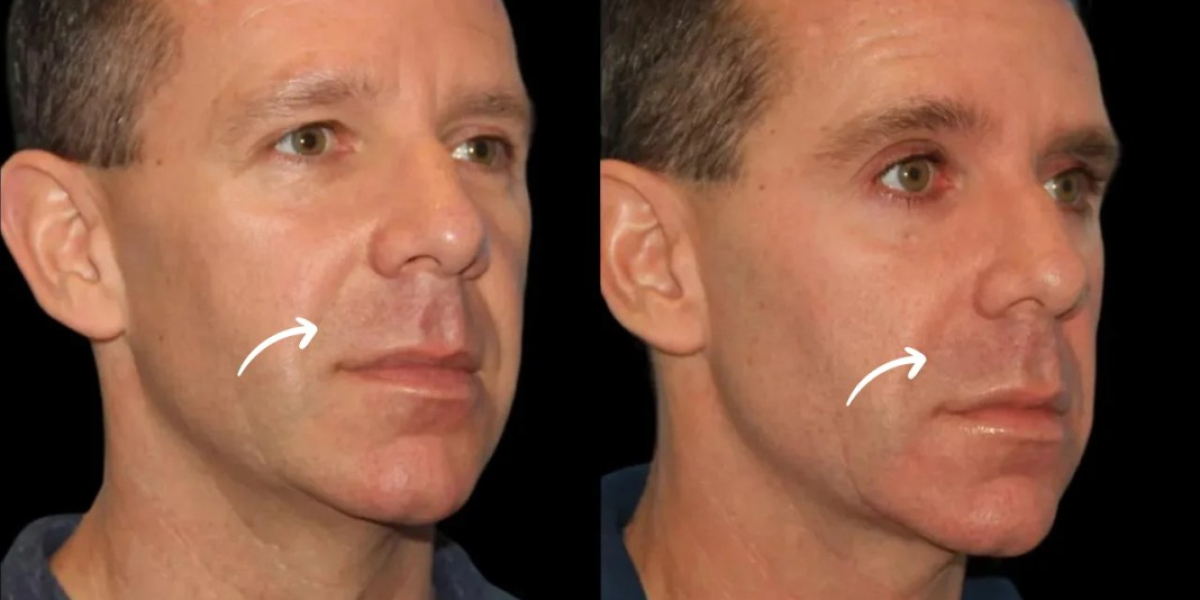 Best Aesthetic Clinics in Dubai for Sculptra Fillers Low Maintenance