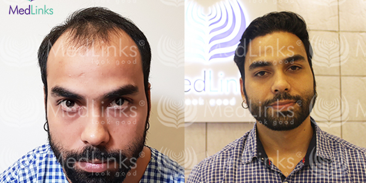 Perfect-i Robotic Hair Transplant – Perfect-i vs FUE | MedLinks