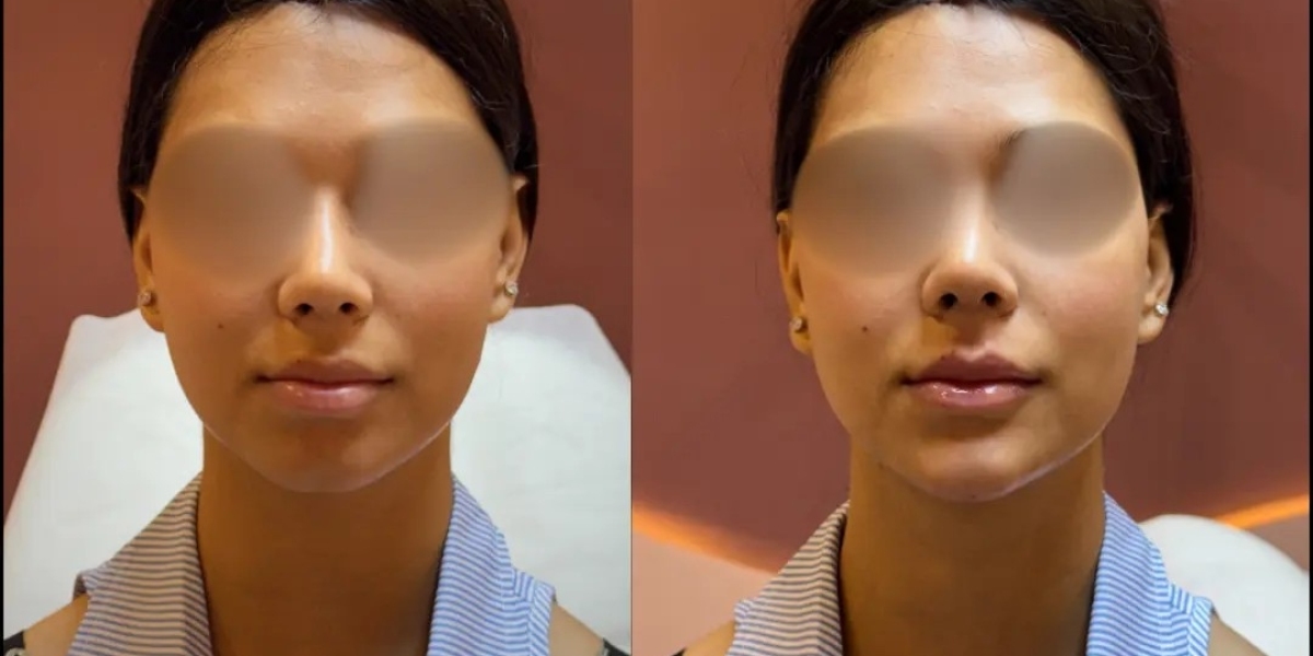 Gynecomastia Surgery in the UK: Exploring Treatment Options in India
