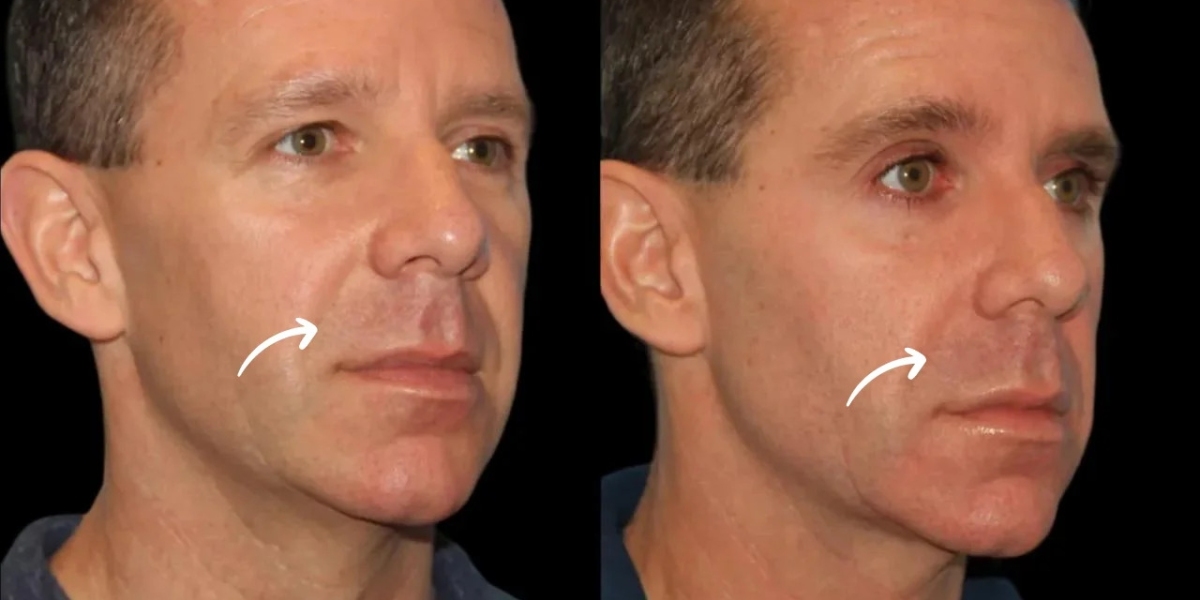Sculptra Treatment in Dubai: How Tissue Characteristics Affect Outcomes