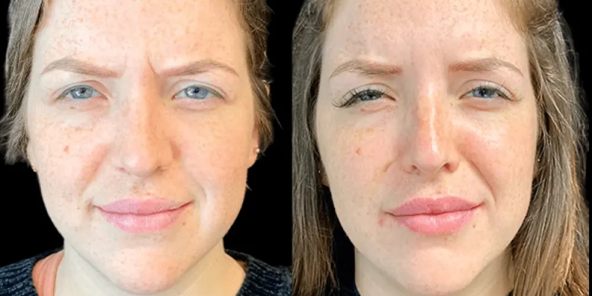 Botox Treatment in Dubai: What to Expect Before and After Results