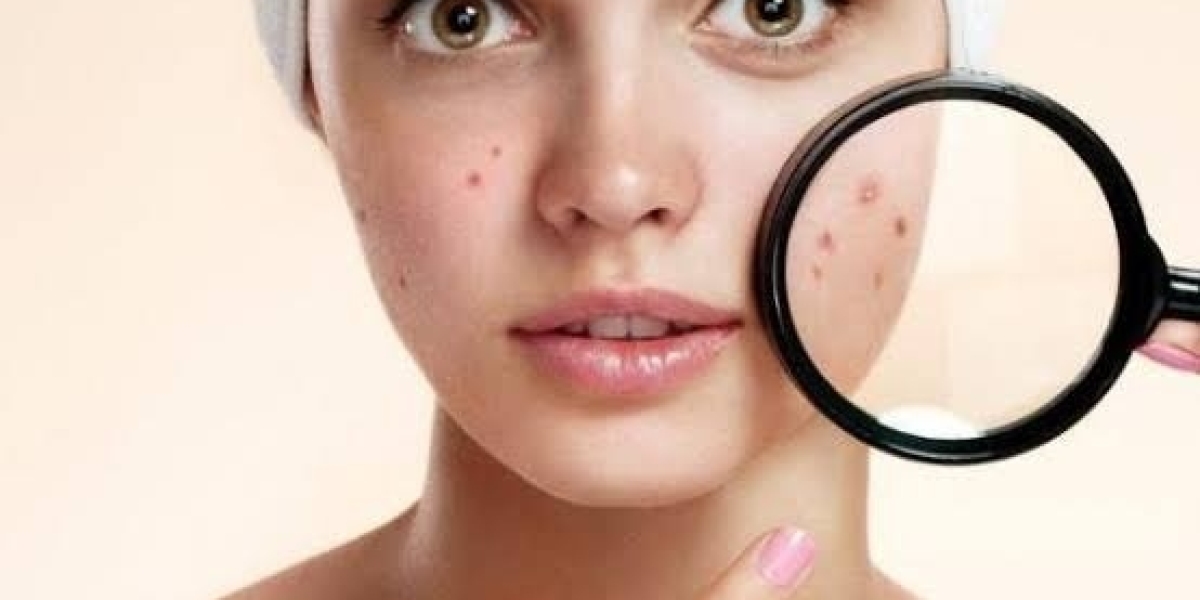 Acne Scar Removal in Dubai - Tailored to Your Scar Type