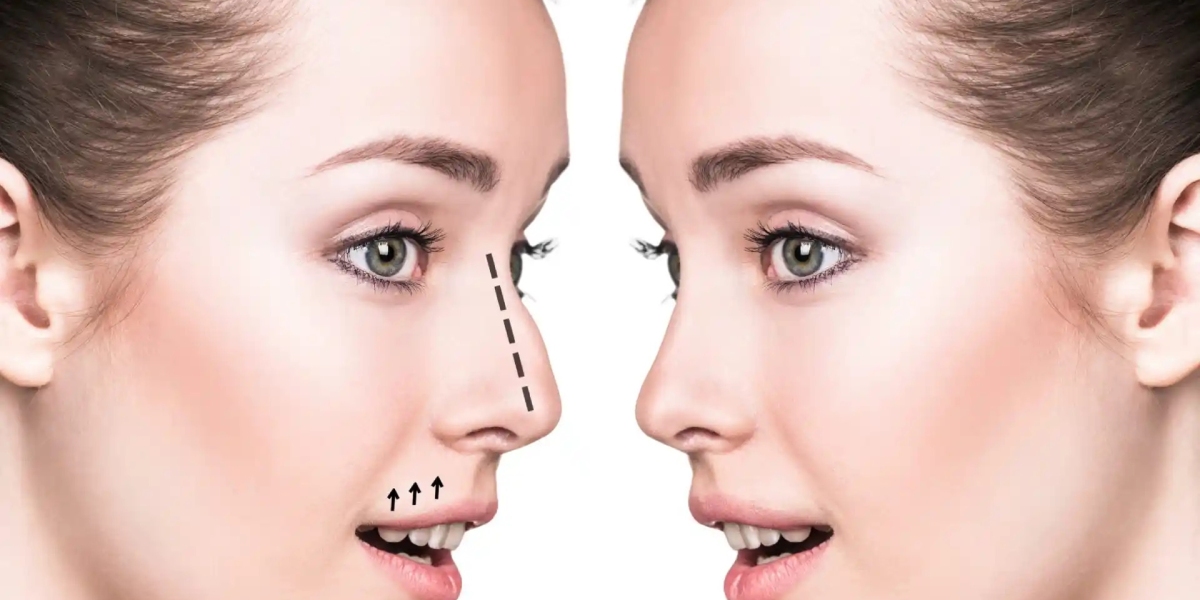 Can Nose Surgery in Dubai Help Correct a Crooked Nose?