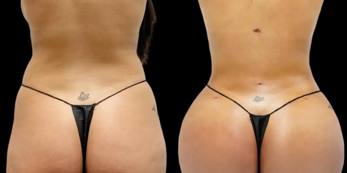 How the Best Doctors in Dubai Address Individual Fat Transfer Goals