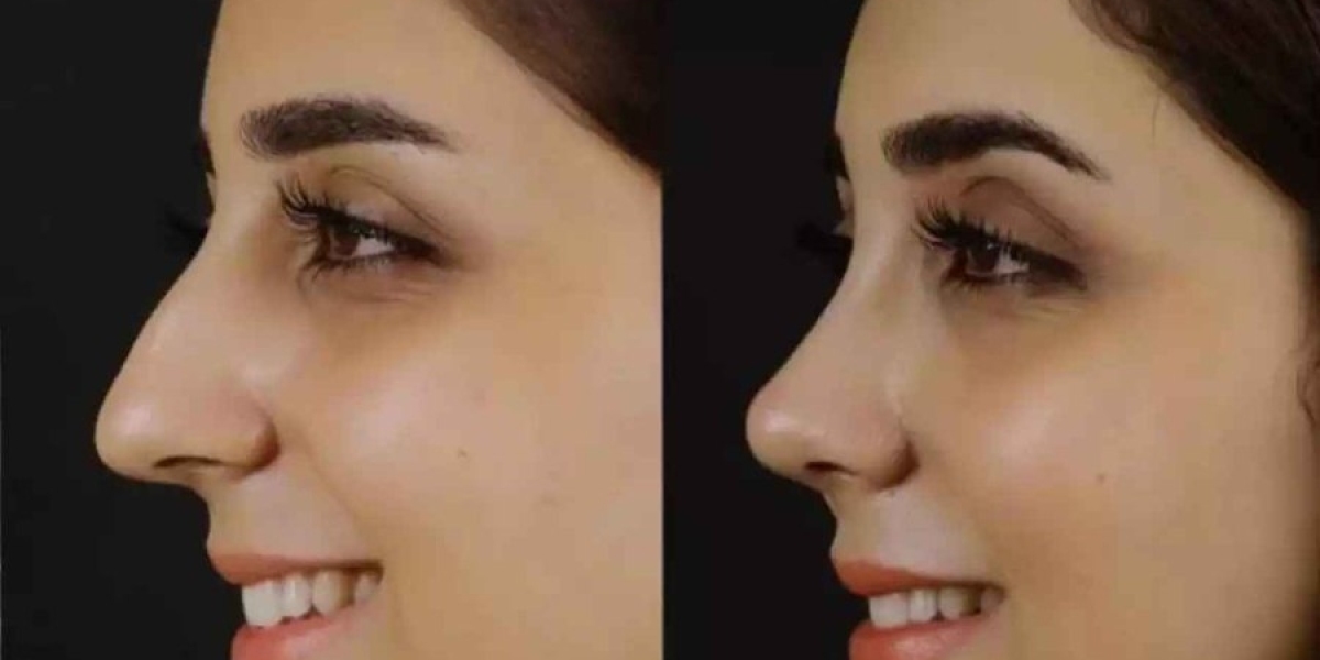 What Symptoms May Require Nose Deviated Septum Surgery in Dubai?