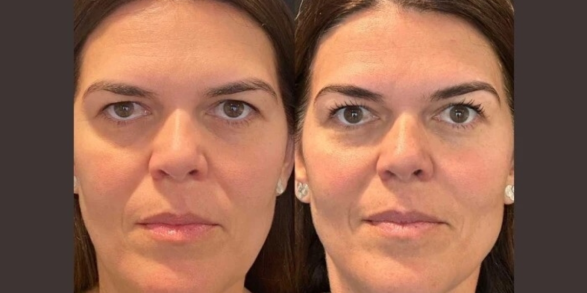 Thread Lift Treatment in Dubai: Facial Rejuvenation Without Extensive Recovery