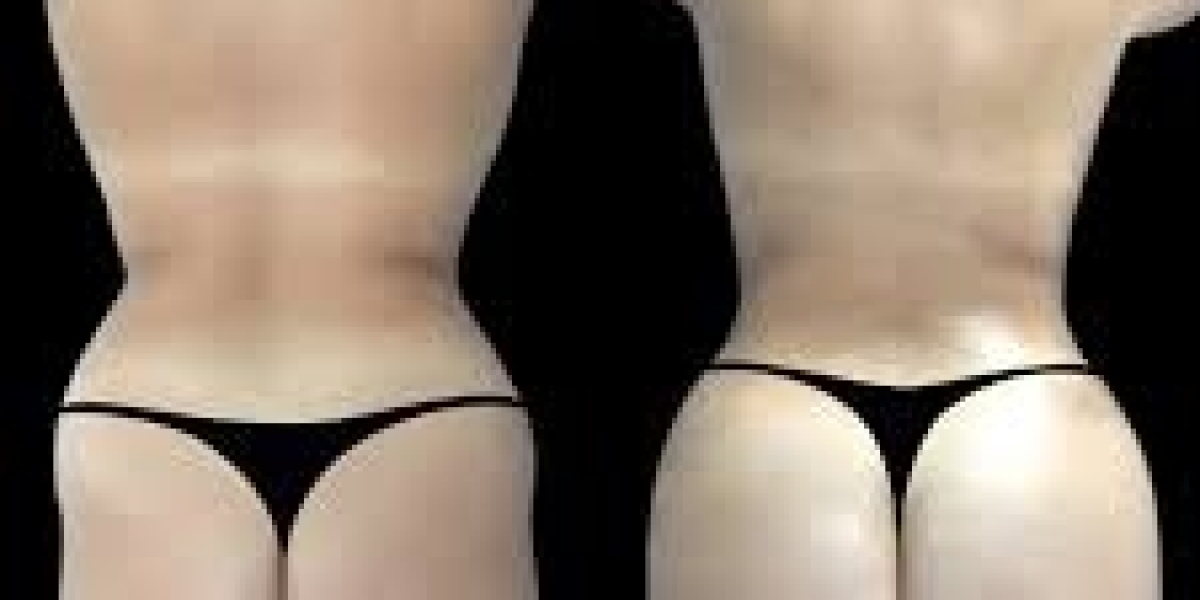 Comparing Butt Fat Transfer Consultations with the Best Doctors in Dubai